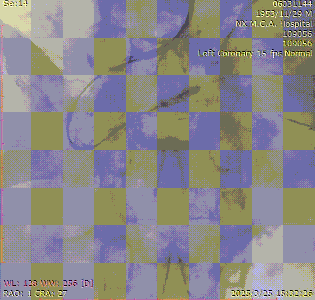 Launcher病例荟 | SAL.75/1.0应用于右冠钙化病变