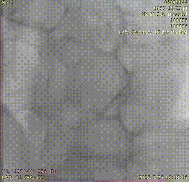 Launcher病例荟 | SAL.75/1.0应用于右冠钙化病变