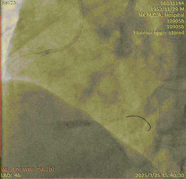 Launcher病例荟 | SAL.75/1.0应用于右冠钙化病变