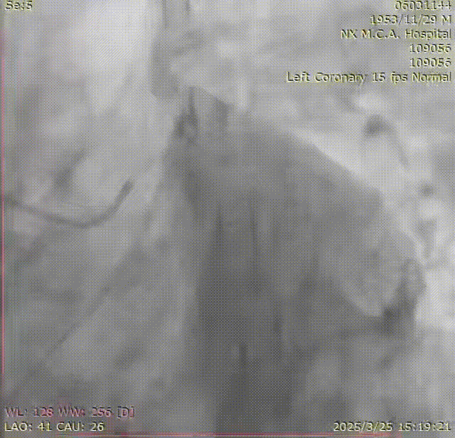 Launcher病例荟 | SAL.75/1.0应用于右冠钙化病变