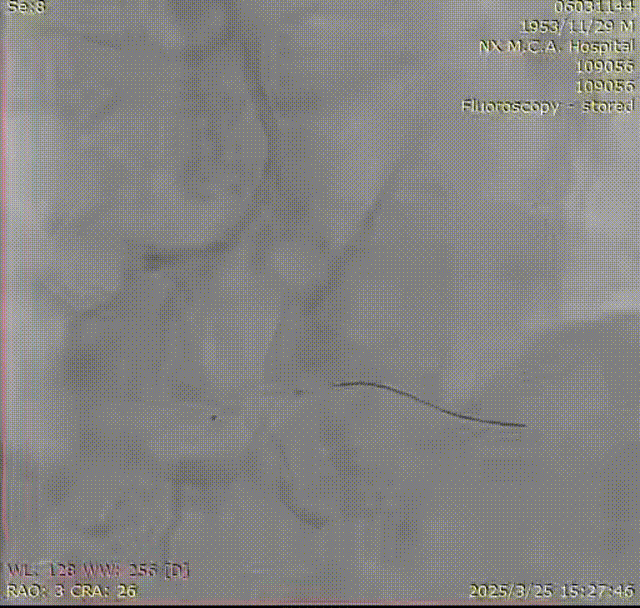 Launcher病例荟 | SAL.75/1.0应用于右冠钙化病变