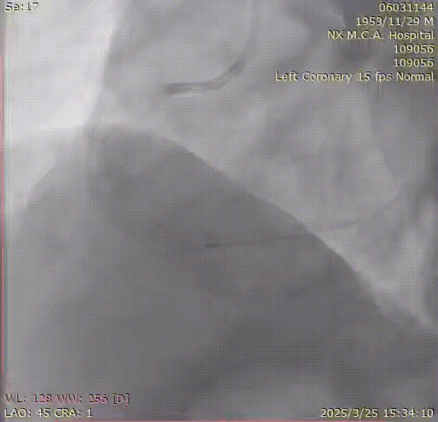 Launcher病例荟 | SAL.75/1.0应用于右冠钙化病变