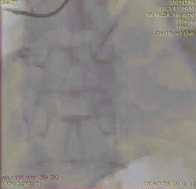 Launcher病例荟 | SAL.75/1.0应用于右冠钙化病变