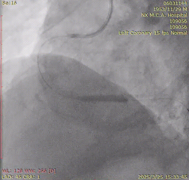 Launcher病例荟 | SAL.75/1.0应用于右冠钙化病变