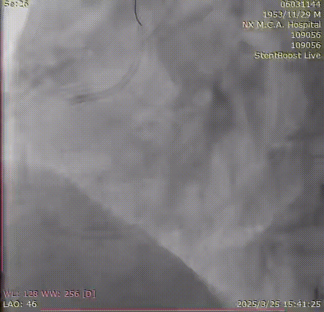 Launcher病例荟 | SAL.75/1.0应用于右冠钙化病变