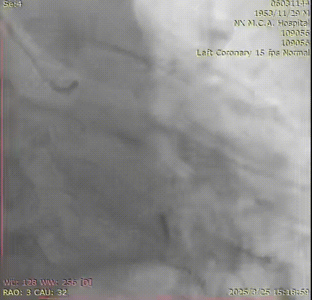 Launcher病例荟 | SAL.75/1.0应用于右冠钙化病变