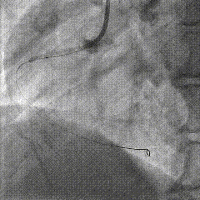 Launcher病例荟 | JR应用于右冠近段病变