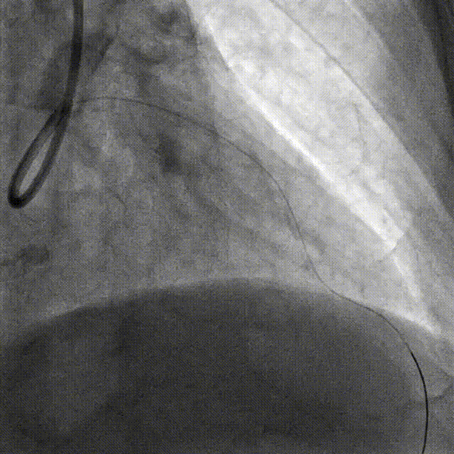 Launcher病例荟 | JR应用于右冠近段病变