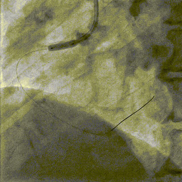 Launcher病例荟 | JR应用于右冠近段病变