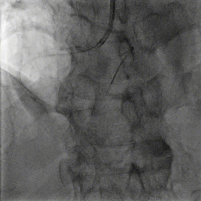 Launcher病例荟 | JR应用于右冠近段病变