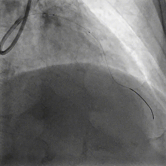 Launcher病例荟 | JR应用于右冠近段病变