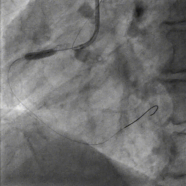 Launcher病例荟 | JR应用于右冠近段病变