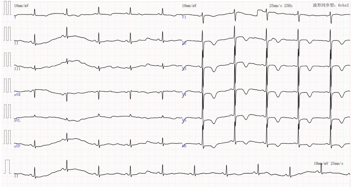 Launcher病例荟 | JR应用于右冠近段病变