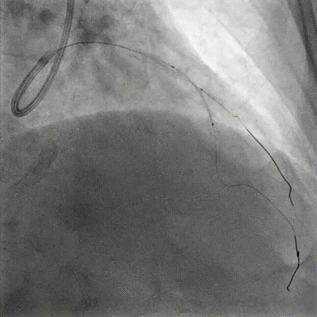 Launcher病例荟 | JR应用于右冠近段病变