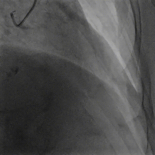 Launcher病例荟 | JR应用于右冠近段病变