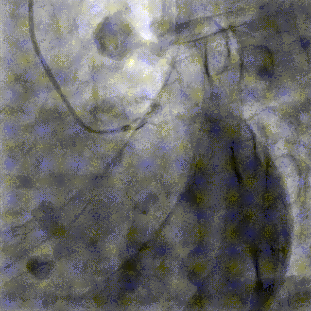 Launcher病例荟 | JR应用于右冠近段病变