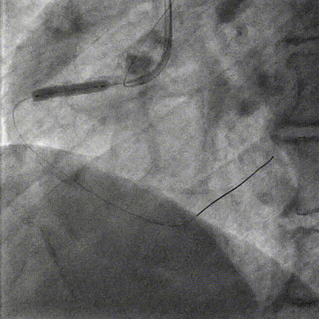 Launcher病例荟 | JR应用于右冠近段病变