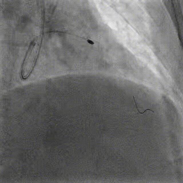 Launcher病例荟 | JR应用于右冠近段病变