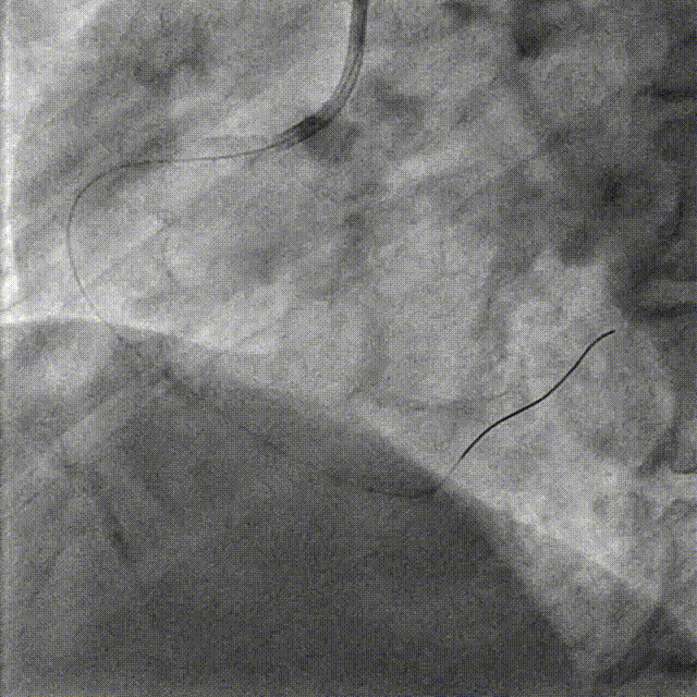 Launcher病例荟 | JR应用于右冠近段病变