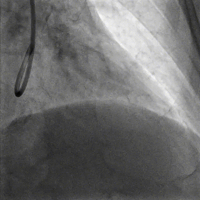 Launcher病例荟 | JR应用于右冠近段病变