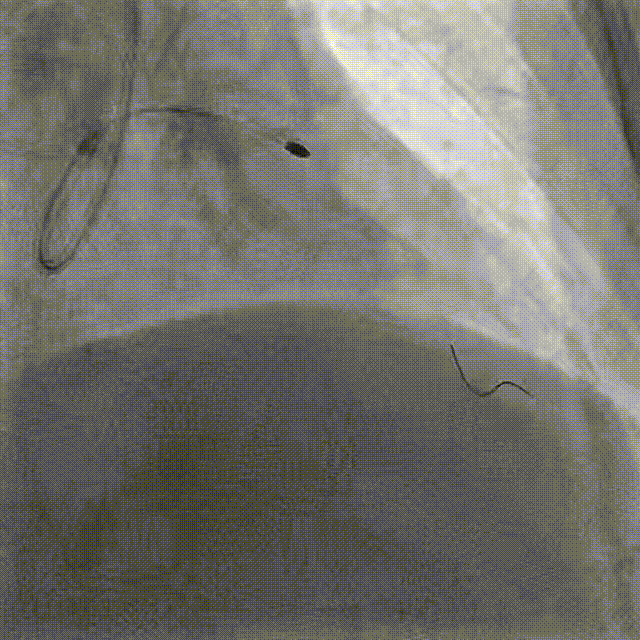 Launcher病例荟 | JR应用于右冠近段病变