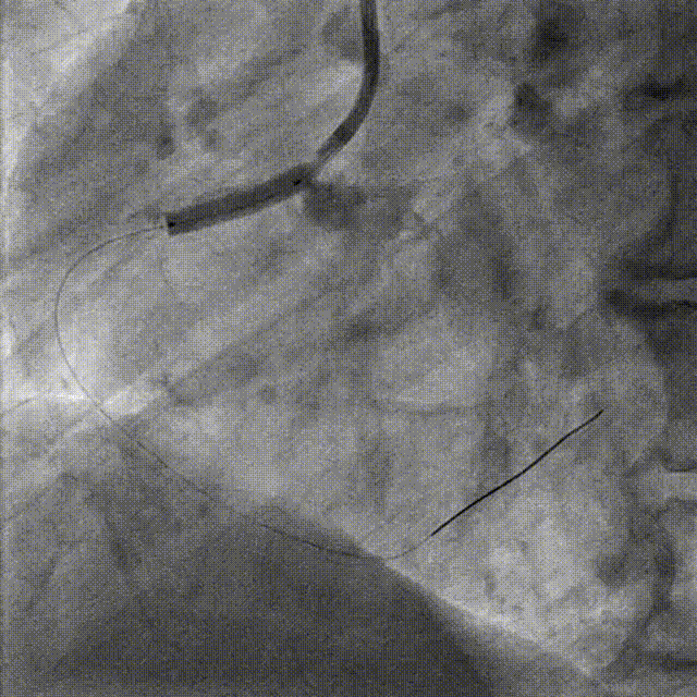 Launcher病例荟 | JR应用于右冠近段病变