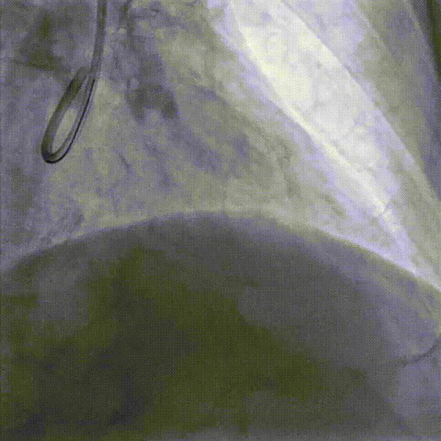 Launcher病例荟 | JR应用于右冠近段病变