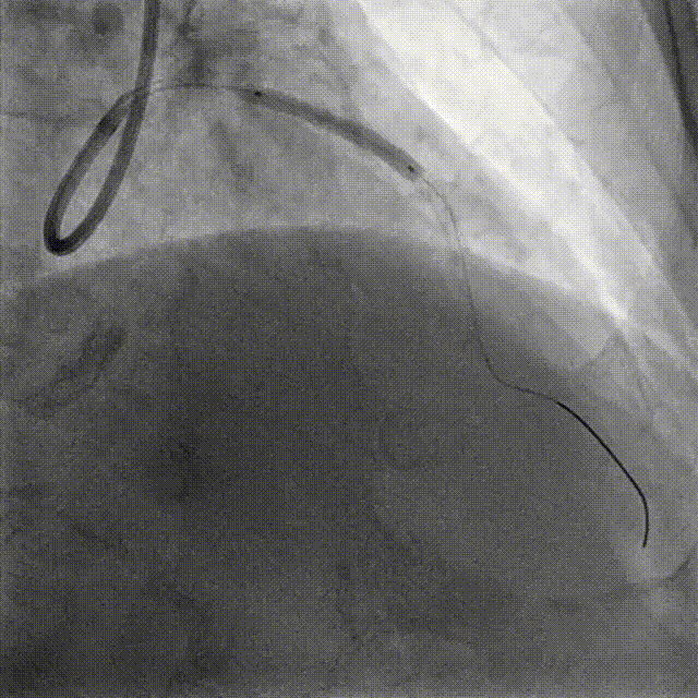 Launcher病例荟 | JR应用于右冠近段病变