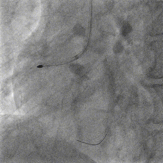 Launcher病例荟 | JR应用于右冠近段病变