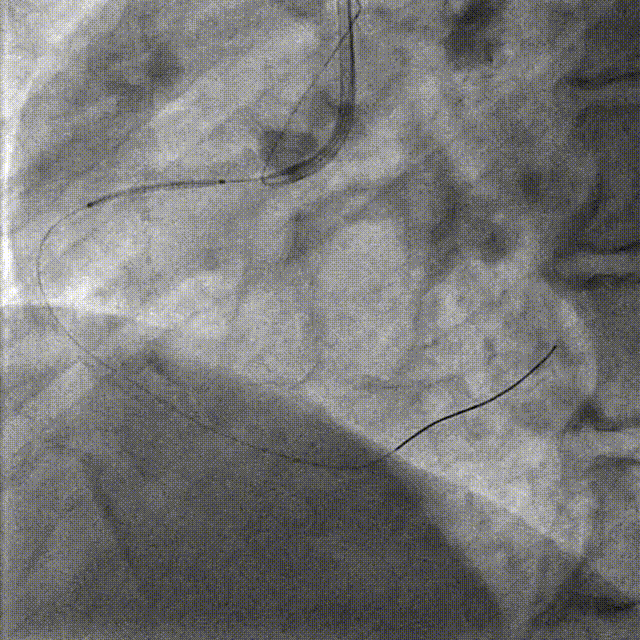 Launcher病例荟 | JR应用于右冠近段病变