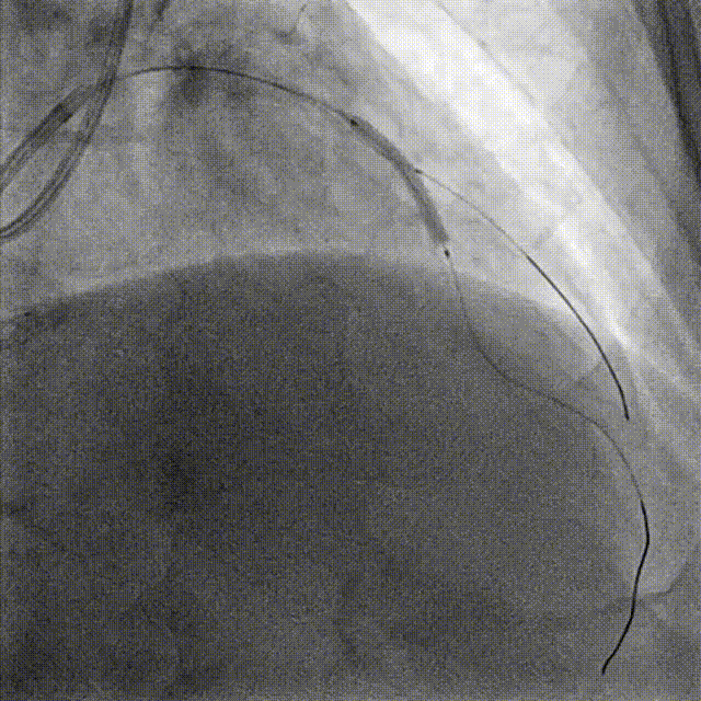 Launcher病例荟 | JR应用于右冠近段病变