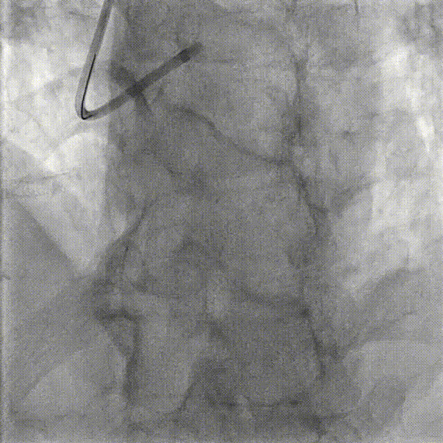 Launcher病例荟 | JR应用于右冠近段病变