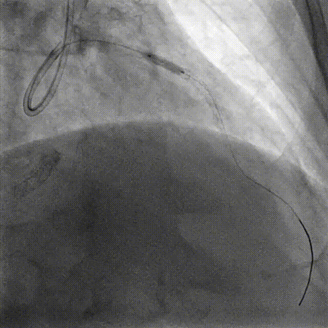 Launcher病例荟 | JR应用于右冠近段病变