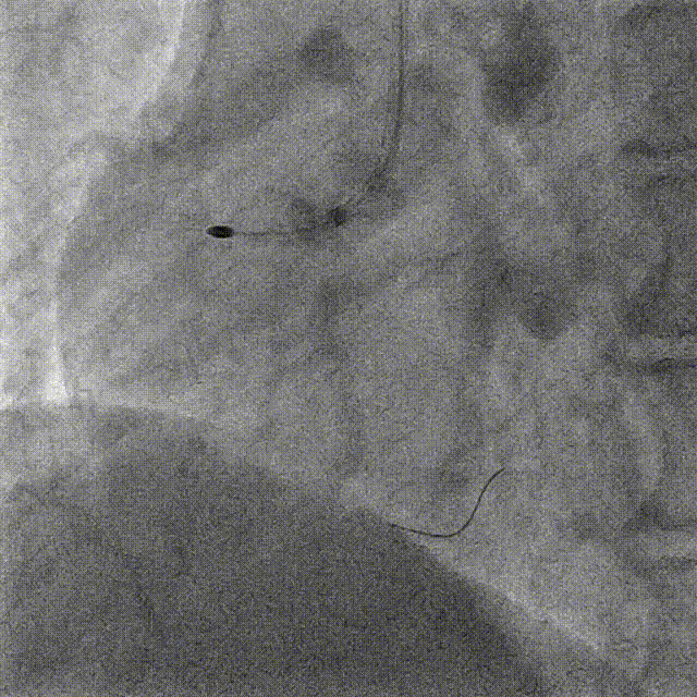 Launcher病例荟 | JR应用于右冠近段病变
