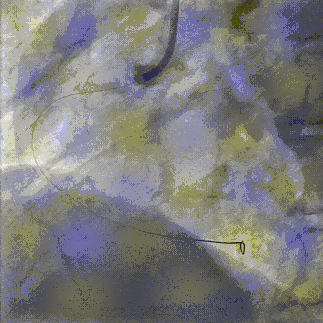 Launcher病例荟 | JR应用于右冠近段病变
