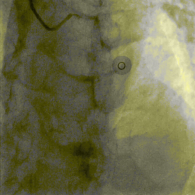 Launcher病例荟 | JR应用于右冠近段病变