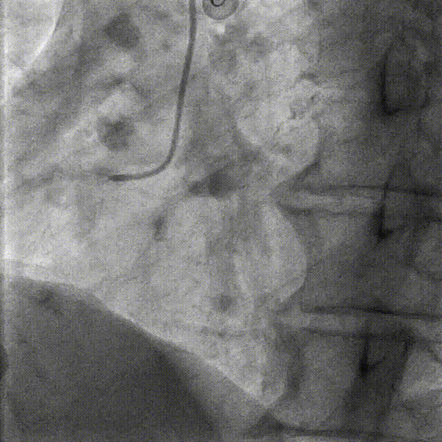 Launcher病例荟 | JR应用于右冠近段病变