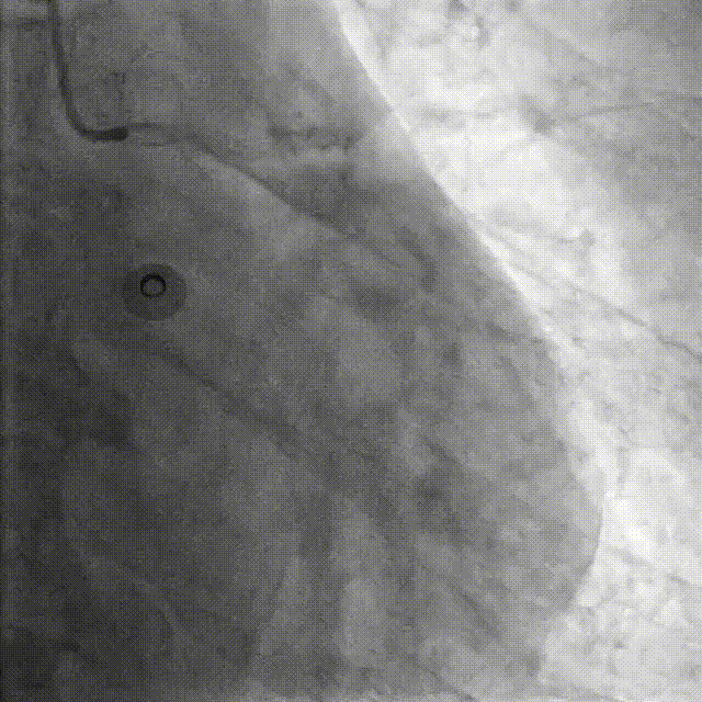 Launcher病例荟 | JR应用于右冠近段病变