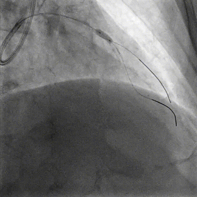 Launcher病例荟 | JR应用于右冠近段病变