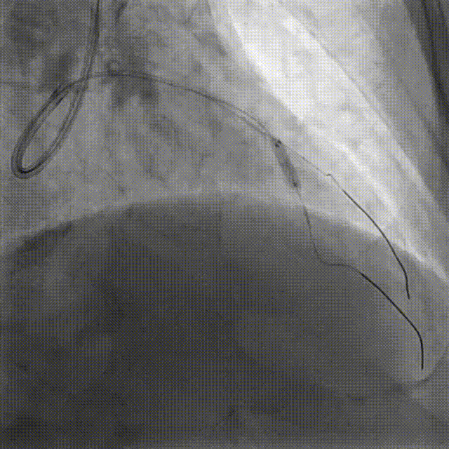 Launcher病例荟 | JR应用于右冠近段病变