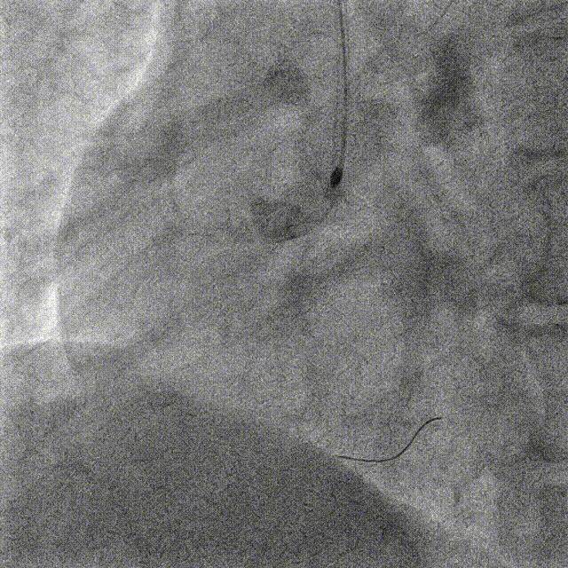 Launcher病例荟 | JR应用于右冠近段病变