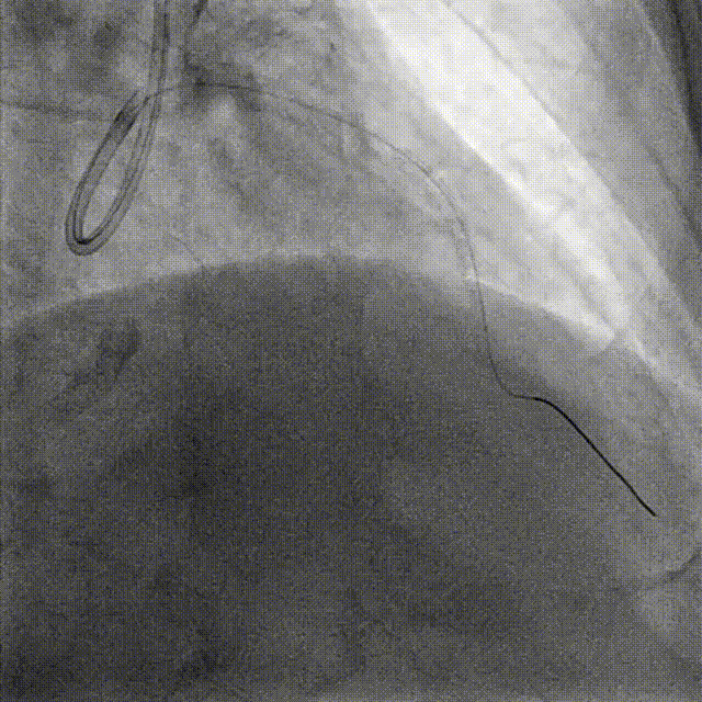 Launcher病例荟 | JR应用于右冠近段病变
