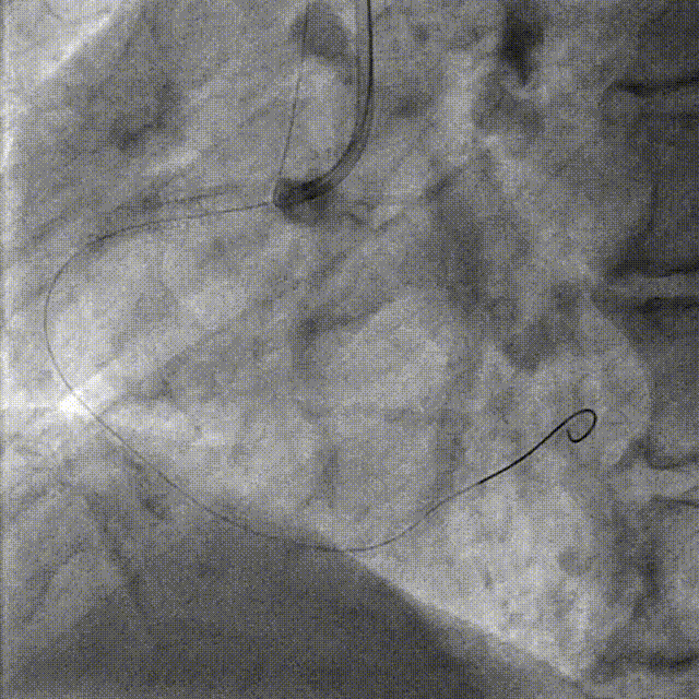 Launcher病例荟 | JR应用于右冠近段病变