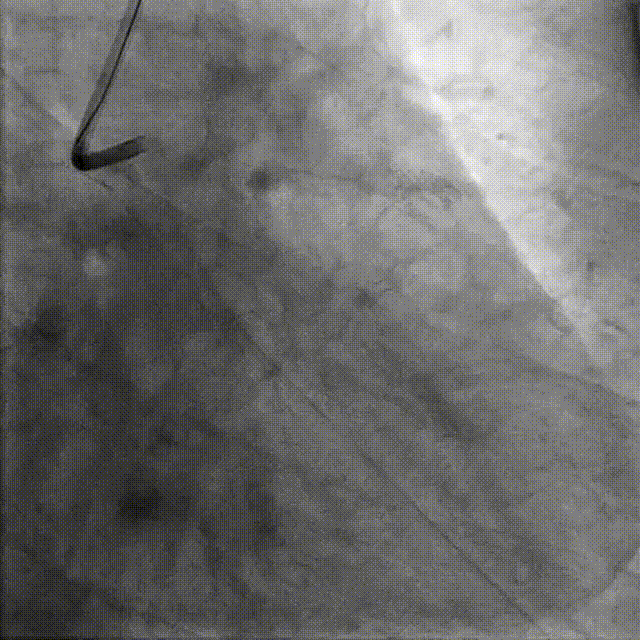 Launcher病例荟 | JR应用于右冠近段病变