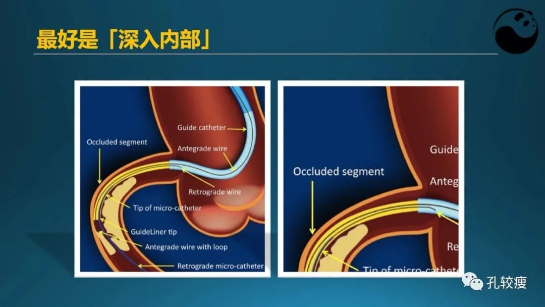 CTO病变主动迎客技术之我见