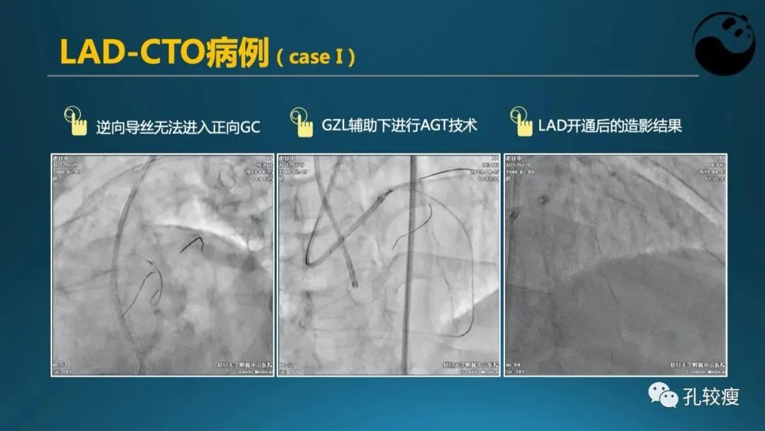 CTO病变主动迎客技术之我见