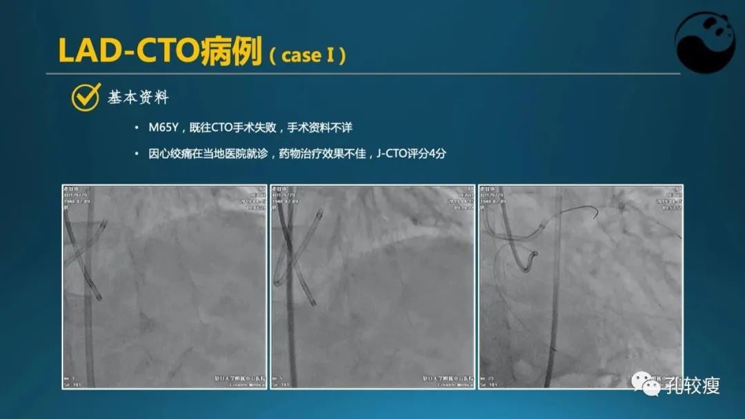 CTO病变主动迎客技术之我见