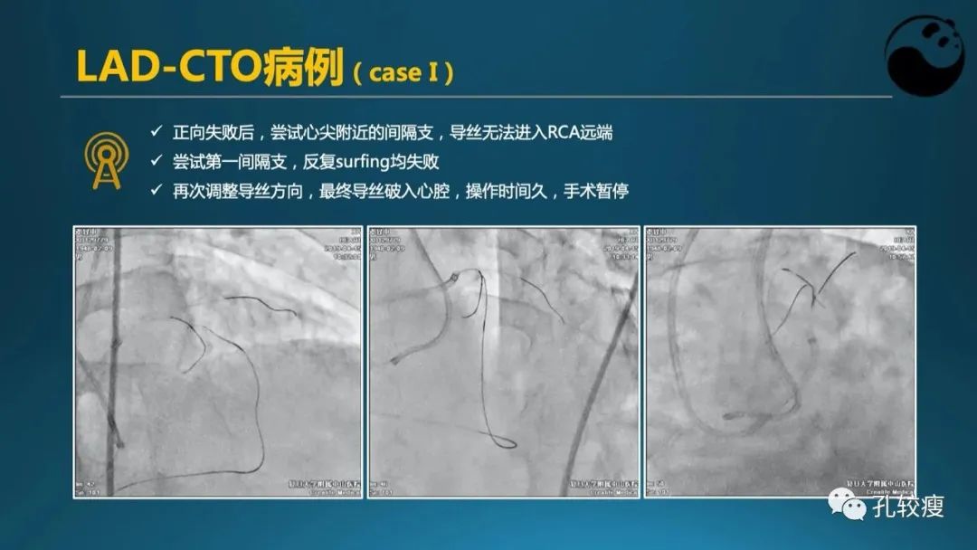 CTO病变主动迎客技术之我见