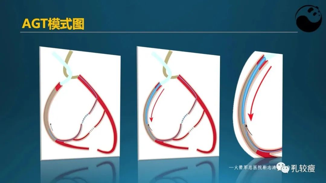 CTO病变主动迎客技术之我见