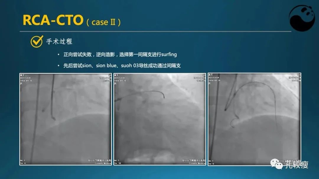 CTO病变主动迎客技术之我见